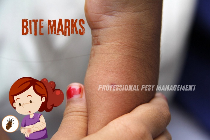 Close-up of bed bug bite marks on a child's arm with 'Bite Marks' text. Promoting Professional Pest Management's bed bug control services in Chennai